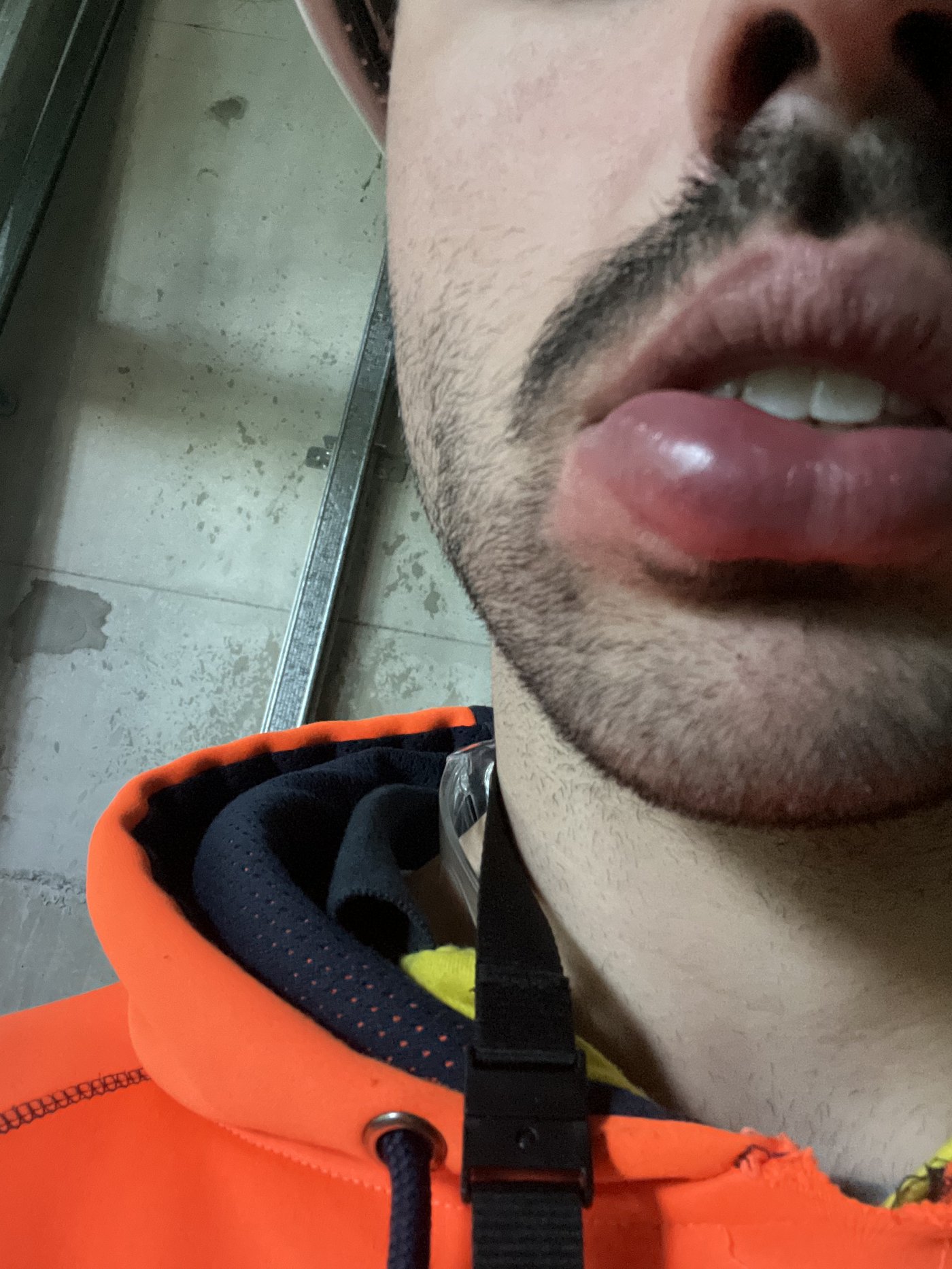 Nathan's health journey - swollen lips