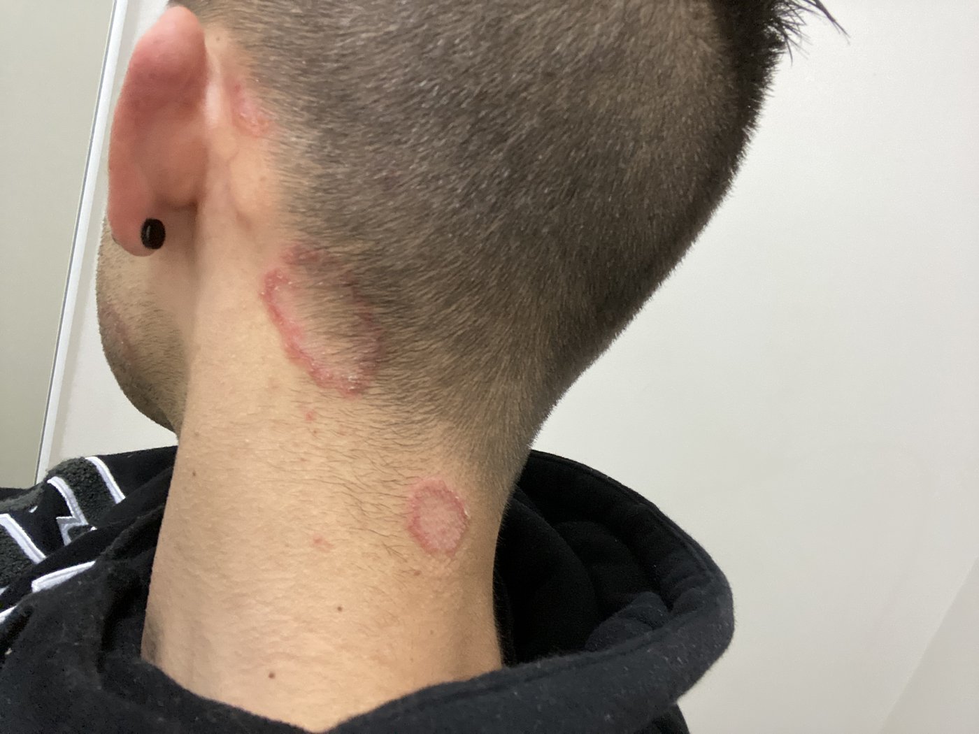 Nathan's health journey - skin lesions